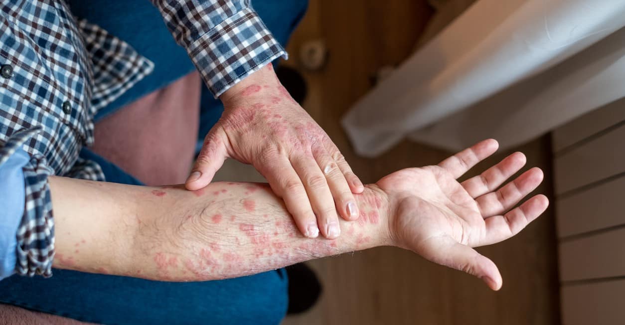 Breaking out in a rash could be a sign of CANCER - here's how tell if you  are at risk