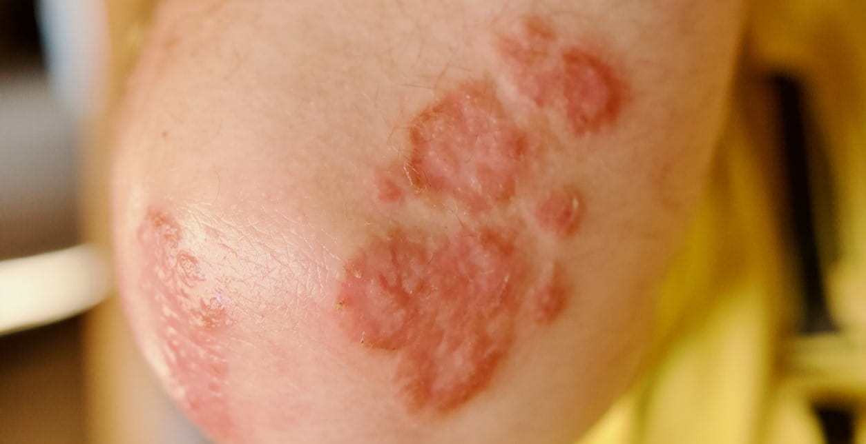 Psoriasis on an arm