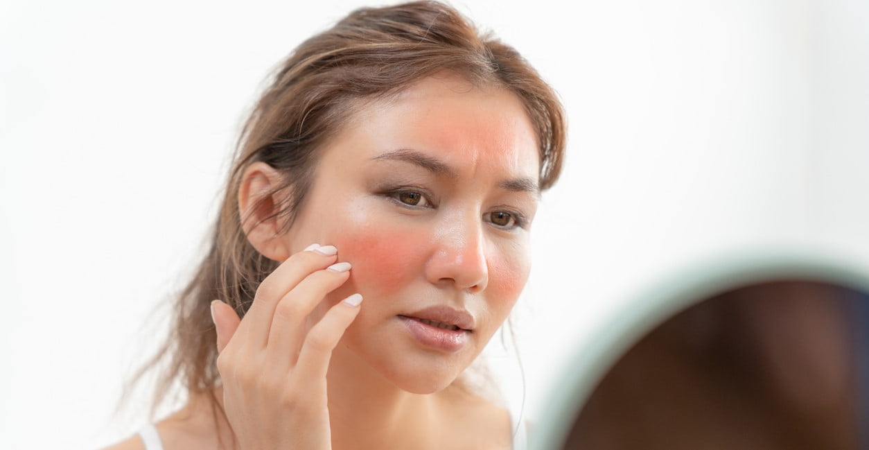 Woman with a flushed face caused by alcohol