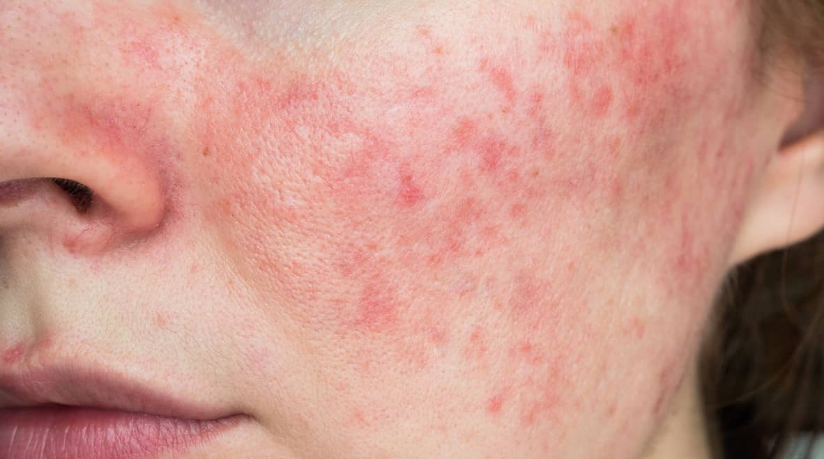 Rosacea on face
